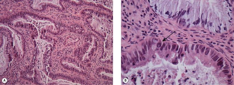 Figure 9-14, The most common, or “endocervical type,” of adenocarcinoma of the cervix. Irregularly shaped, mucin-poor, glandular arrangements of cells penetrate the cervical stroma (A). In (B), irregular pseudostratification of the epithelium with mitoses (arrow) can be seen. Necrotic debris is identifiable in the lumen. This material is responsible for the diathesis debris noted in the cytologic specimen. No cilia are present in the vast majority of adenocarcinoma types (H&E, ×MP).