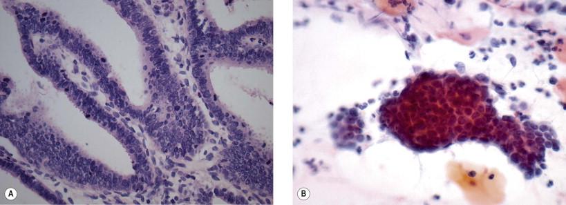 Figure 9-15, Villoglandular endocervical adenocarcinoma is a well-differentiated neoplasm with a better prognosis than the more common “endocervical type” of adenocarcinoma. (A) Villous fronds with stromal cores are present and (B) can also be seen as smooth contoured groups in the correlative cytology sample (A: H&E stain ×MP; B: conventional smear; Papanicolaou, ×HP).