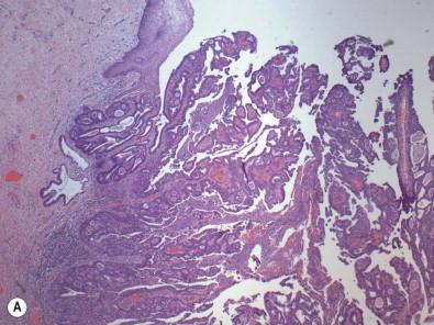 Figure 9-16, Endocervical adenocarcinoma of the usual type, with an exophytic growth pattern. Histologic (A) and concurrent cytologic appearance (B,C) . Although this tumor shows an architectural pattern similar to the villoglandular adenocarcinoma in Fig. 9-15 , because it is a higher grade tumor (D) it technically should not be classified as the favorable prognosis variant.