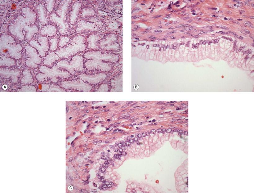 Figure 9-17, Well-differentiated endocervical adenocarcinoma (“adenoma malignum”) closely mimics normal endocervical epithelium (compare with Fig. 9-1 ); however, it deeply penetrates the cervical stroma (A). A high magnification of the lesion shows basally placed nuclei and vacuolated apical cytoplasm (B). In most cases, a careful search will find some areas showing nuclear atypia, including enlargement, irregular nuclear contours, and the presence of nucleoli (C) (H&E, A ×LP, B,C ×HP).