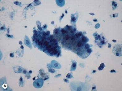 Figure 9-18, In these examples of cells derived from well-differentiated mucinous endocervical adenocarcinoma (“adenoma malignum”), one can see subtle nuclear pleomorphism of size and shape with contour irregularities. (A) Note the abnormal group on the right which as compared with the normal endocervical group on the left shows substantial increase in nuclear size. (B) Note the golden brown appearance to the frothy mucin in the cytoplasm. (C) An example of a pseudostratified strip of cells is noted in (C). These strips contain more cytoplasm and show N : C ratios much lower than are seen in the usual forms of adenocarcinoma and AIS. (D) A 2-dimensional (flat) sheet of cells with prominent nucleoli is noted (liquid-based preparations, Papanicolaou, ×HP).