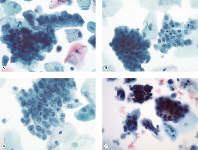 Figure 9-20, Endocervical adenocarcinoma can present with many of the architectural features noted in AIS. However, as the tumors become more poorly differentiated, these features become more difficult to discern. (A) A poorly composed strip of cells. Because these lesions are less cohesive than more differentiated counterparts, isolated cells are more common. (B,C) Examples of flat, honeycombed sheets of malignant cells with prominent macronucleoli in every cell. Such features can sometimes be difficult to distinguish from typical and atypical epithelial repairs (see Figs 9-30 and 9-31 ). (D) An ill-defined rosette and a “bird tail” strip of cells. A granular, “clinging,” diathesis pattern is present in the background (liquid-based preparations, Papanicolaou, ×HP).