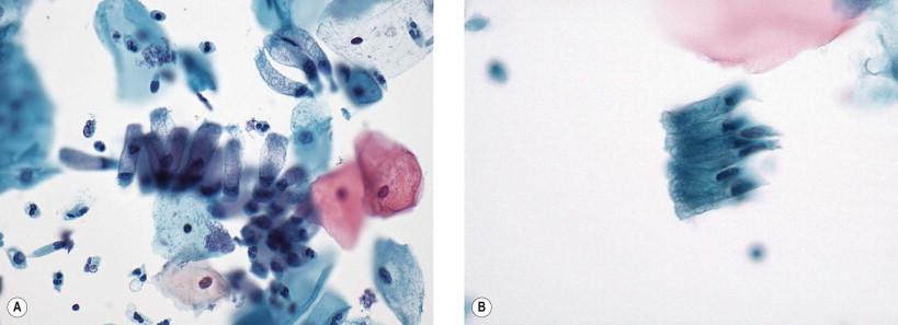 Figure 9-2, Typical “picket-fence” appearance in a cytologic specimen of directly sampled endocervical cells of the type noted in Fig. 9-1 . When viewed from the side, an identical appearance of basal nuclei and mucous apical cytoplasm is present (liquid-based preparation, Papanicolaou, A ×MP, B ×HP).