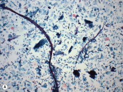 Figure 9-22, (A) Colonic adenocarcinoma which invades the lower gynecologic tract often shows a background of vegetable material, shown here as stranded fibers. The presence of significant amounts of this material in the background should raise the possibility of a metastasis. (B) Colonic adenocarcinoma can look very similar to endocervical adenocarcinoma presenting as pseudostratified strips of cells (liquid-based preparations, Papanicolaou, A ×LP, B ×HP).