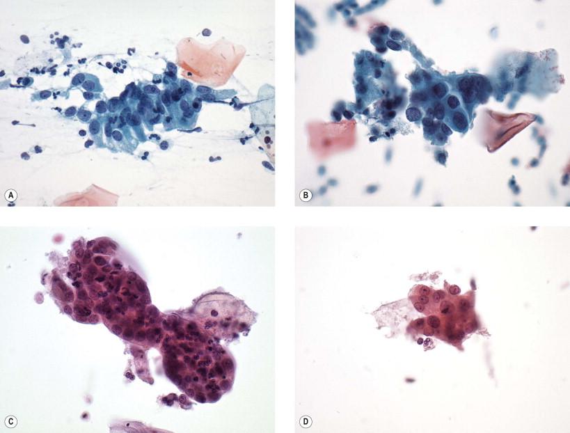 Figure 9-23, Examples of cases interpreted as “atypical endocervical cells, not otherwise specified” show the spectrum of changes that can be associated with reactive and/or neoplastic follow-up. In (A) a loosely cohesive pseudostratified strip of endocervical cells is present. Nuclei are slightly enlarged, but N : C ratios are generally lower than noted in classic AIS. The chromatin pattern is generally smooth without the coarse pattern of neoplastic lesions. This case showed benign follow-up. (B) A disorganized group of endocervical cells with enlarged hyperchromatic nuclei. Although no architectural features of AIS were identified, the case was found to represent AIS on follow-up. (C) A smooth contoured hyperchromatic crowded group of columnar endocervical cells. Abundant inflammation is associated. Although the nuclei are larger than normal and show some coarse chromatin, this case was found to be associated with an irritated endocervical polyp. (D) Nuclear atypia with prominent nucleoli is illustrated, but with a low N : C ratio. On histologic follow-up this was found to represent a “repair-like” AIS (liquid-based preparation, Papanicolaou, ×HP).