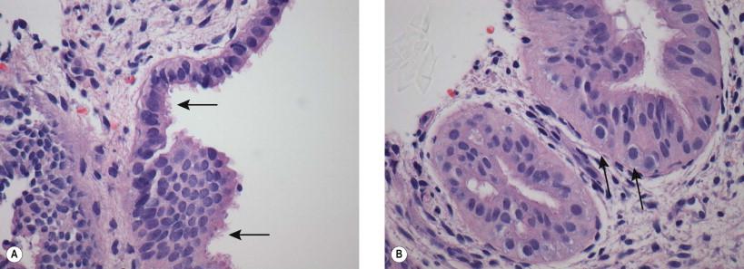 Figure 9-4, Two histologic sections found higher in the endocervical canal than that shown in Fig. 9-1 . As the mucosa nears the lower uterine segment, pseudostratification and the presence of the three cell types noted in tubal metaplasia can often be found. (A) Note the presence of a prominent ciliated mucosal border (arrows). (B) Peg cells are noted within the epithelium (arrows) (H&E, ×HP).