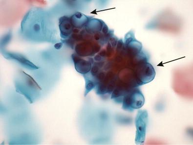 Figure 9-5, In this tight grouping of endocervical epithelial cells, mucin-containing peg cells (arrows) are noted along with densely packed intercalated cells (liquid-based preparation, Papanicolaou, ×HP).