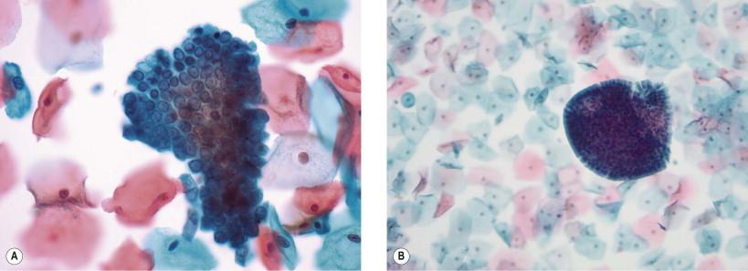 Figure 9-7, Tubal metaplasia can present as (A) small or (B) large hyperchromatic crowded groups, especially when sampling devices obtain cells from high in the endocervical canal. (A) Examination of the group shows a crowded, but uniform, architectural honeycombed pattern. Nuclei are relatively uniform and show finely granular, homogeneous euchromatin. (B) In this low magnification example, the cells around the margins show clearly identifiable, even columnar appearance (liquid-based preparation, Papanicolaou, A ×HP, B ×LP).