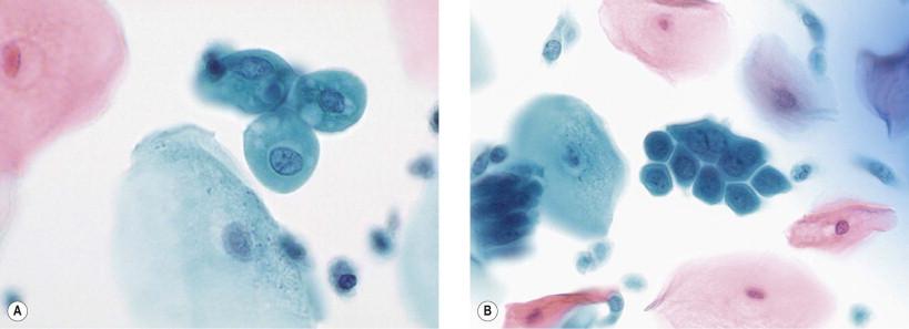 Figure 9-9, Spontaneously exfoliated endocervical cells (not directly abraded by the sampling device) travel in the endocervical mucus and will “round-up” in a fashion similar to cells suspended in fluid medium. This process can change cells from a columnar to a rounded configuration. Such cells may closely mimic metaplastic squamous cells (A). Close attention to cytoplasmic granularity, the presence of vacuoles, and the character of the nuclei – showing evenly distributed, finely granular chromatin, and small, but well-defined micronucleoli – can aid in their correct identification. In some cases, directly sampled endocervical cells can present in loosely aggregated honeycombed configurations that also mimic metaplastic (or even dysplastic) squamous cells (B) (liquid-based preparation, Papanicolaou, ×HP).