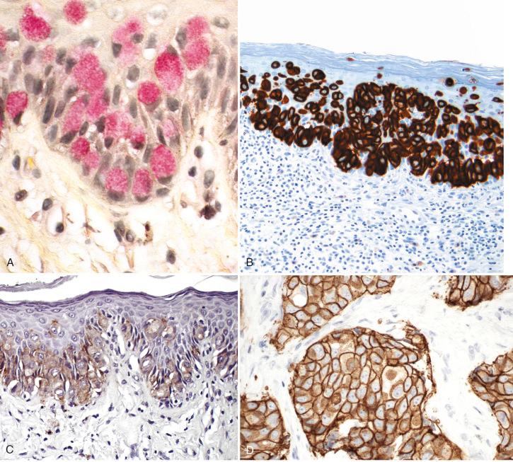 Fig. 7.5, Markers for Paget disease. A, A mucicarmine stain highlights individual cells. B, Cytokeratin (CK)-7 staining. C, Strong immunopositivity for carcinoembryonic antigen (CEA). D, Staining for Her-2-neu.