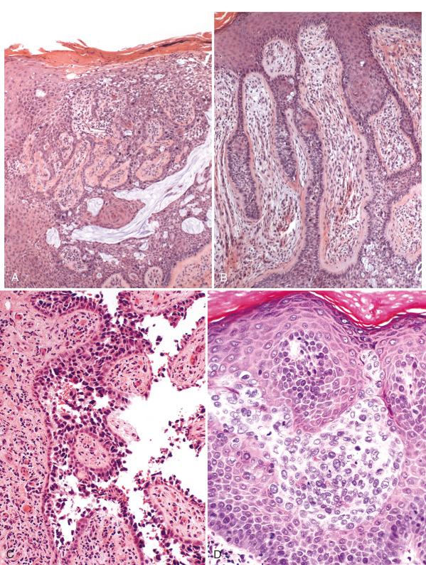 Fig. 7.6, A, Epithelial hyperplasia associated with Paget disease with dense stromal fibrosis. B, Note the dense fibrous appearance of the intervening stroma at higher power. Other patterns that may cause diagnostic confusion include: acantholysis with tombstones simulating an acantholytic dermatosis (C) and Pagetoid vulvar intraepithelial neoplasia (VIN) (D).