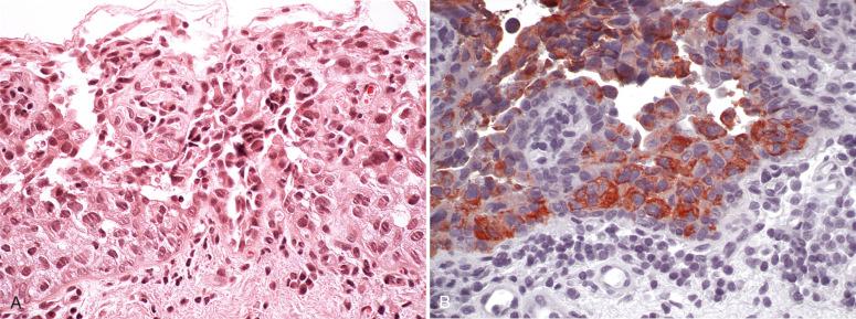 Fig. 7.7, A, Urothelial carcinoma simulating Paget disease. B, Following staining for low-molecular-weight cytokeratins (CKs).