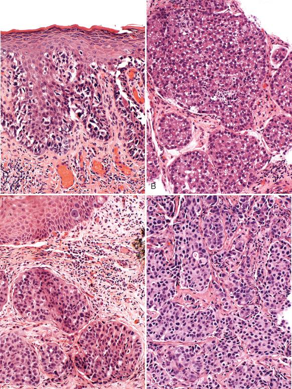 Fig. 7.8, A, Paget disease confined to the epithelium. B, Invasion of the stroma as poorly differentiated cohesive aggregates. C, Early stromal invasion. D, Deeply invasive Paget disease.