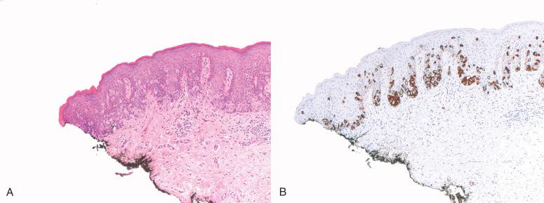 Fig. 7.9, A, Paget disease involving inked margin (left). B, Paget disease involving the inked margin, highlighted by a cytokeratin (CK)-7 stain.