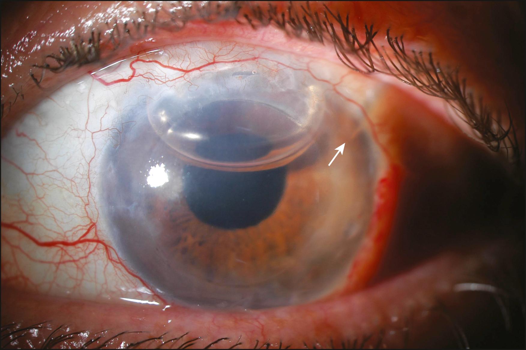 Fig. 117.1, Air bubble in anterior chamber 1 day after Descemet stripping endothelial keratoplasty in an eye with a preexisting glaucoma drainage device (GDD). White arrow points to GDD tube in superior temporal region of the anterior chamber.