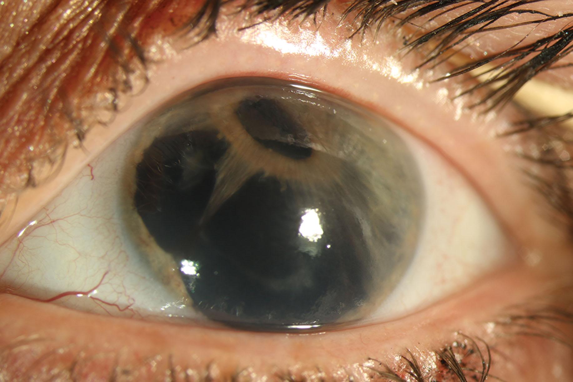 Fig. 10.19.2, Hole Formation in Progressive Iris Atrophy.