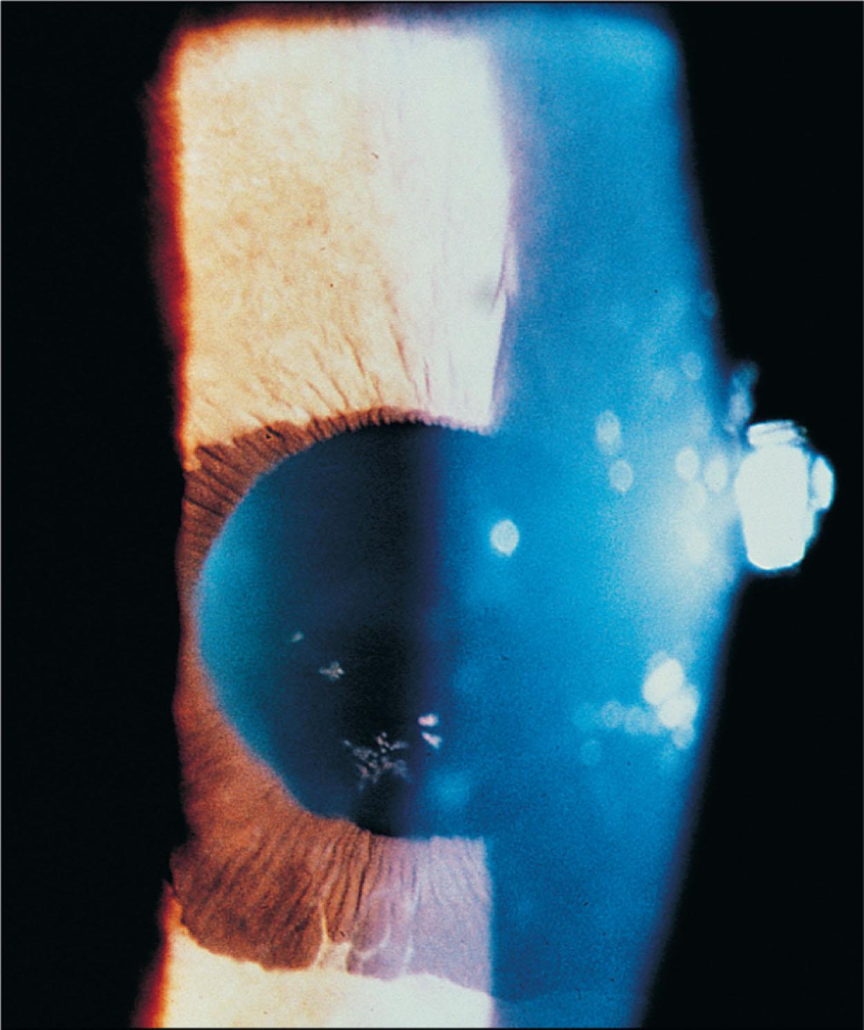 Fig. 10.19.3, Corneal Edema and Iris Findings Are Typical of Chandler’s Syndrome.