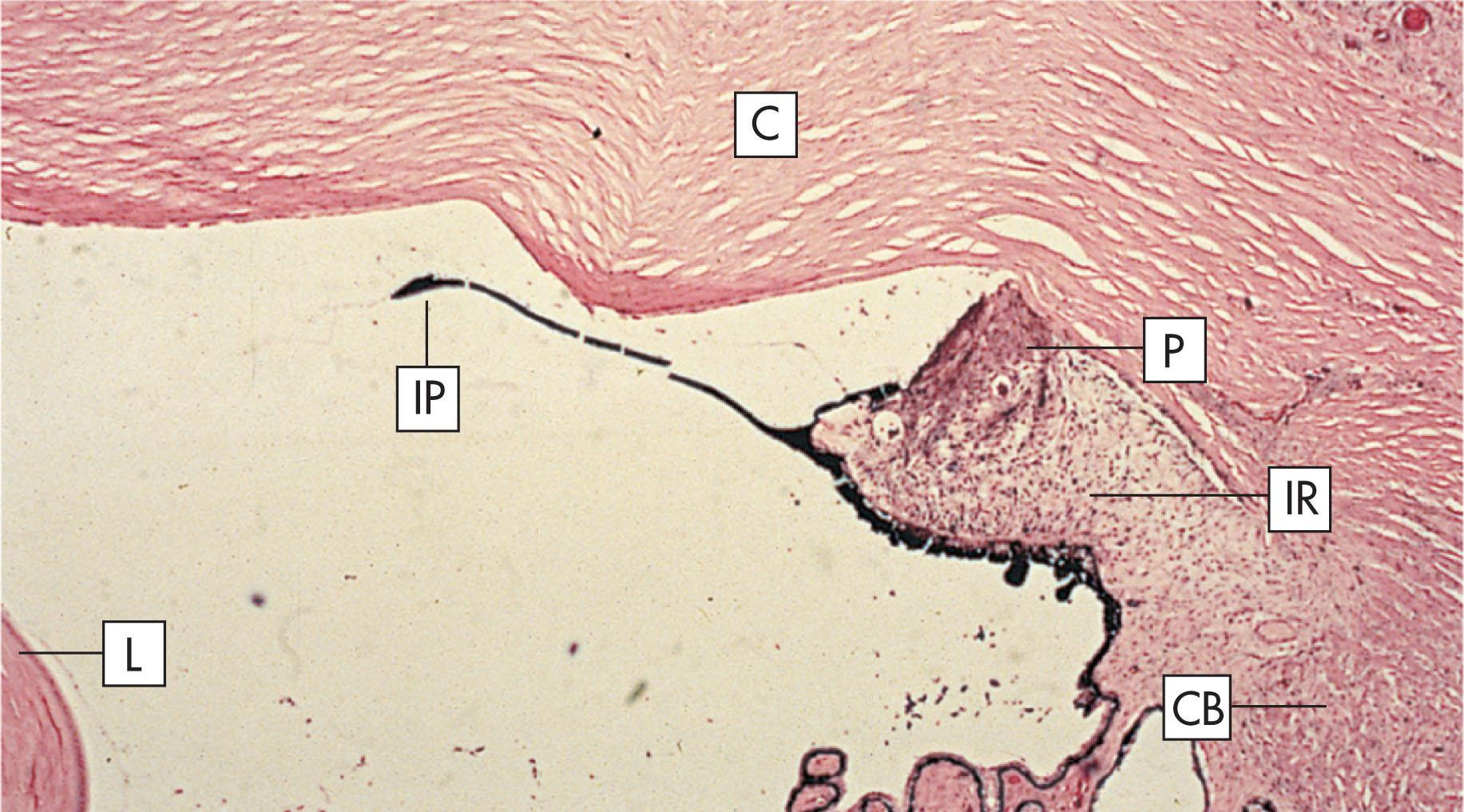 Fig. 10.19.4, Iridocorneal Endothelial Syndrome.