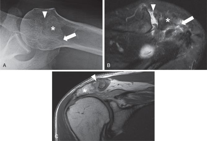 Fig. 38.11, (A) Axillary radiograph depicts an os acromiale and its synchondrosis with the acromion. (B) Axial fat-suppressed T2-weighted image demonstrates an os acromiale with degeneration at the synchondrosis and increased signal on either side of the synchondrosis suggesting instability. Note the chondral denudation over the acromioclavicular (AC) joint and effusion. (C) Oblique coronal fast spin echo image shows severe narrowing of the acromiohumeral interval and a chronic full-thickness supraspinatus tendon tear with retraction of the tendon medial to the glenoid. Os acromiale (*) , synchondrosis (arrows) , AC joint (arrowheads) .