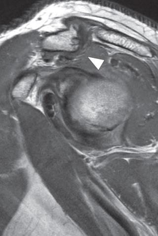 Fig. 38.12, Osteoarthritis of the acromioclavicular joint. A sagittal oblique fast spin echo image shows bony and capsular hypertrophy with an inferiorly directed spur resulting in mass effect upon the supraspinatus muscle tendon junction (arrowhead) .