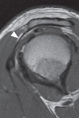 Fig. 38.13, Coracoacromial ligament. An oblique sagittal fast spin echo image demonstrates a normal coracoacromial ligament (arrowhead) extending from the coracoid process to the anterior acromion. The normal ligament measures less than 2 mm in thickness.