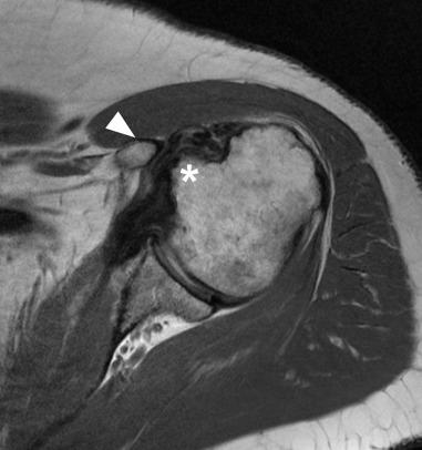 Fig. 38.14, Subcoracoid impingement. An axial fast spin echo image at the level of the coracoid process (white arrowhead) demonstrates narrowing of the coracohumeral interval with attenuation of the superior fibers of the subscapularis. Lesser tuberosity (*) .