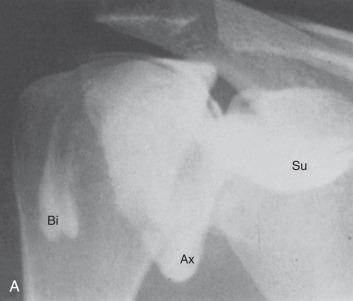 Fig. 38.2, Normal shoulder arthrography. (A) Contrast material is seen within the glenohumeral joint. (B) Early contrast filling in a joint during an arthrogram. Note the absence of contrast material near the needle tip and the normal contour of the axillary pouch. This procedure was performed from an anterior approach over the lower third of the joint. Ax, Axillary recess; Bi, bicipital tendon sleeve; Su, subscapularis recess.