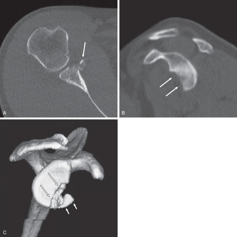 Fig. 38.3, An osseous Bankart lesion demonstrated on a computed tomography scan of the shoulder. (A) An axial computed tomographic image shows a large osseous Bankart lesion with a slightly displaced and comminuted fracture fragment (arrow) involving the inferior glenoid rim. (B) Sagittal reconstruction shows the size of the osseous defect (arrows) of the inferior glenoid rim. (C) A three-dimensional reconstruction shows the relationship of the fracture fragment (short arrows) with the glenoid rim osseous defect (long arrows) .