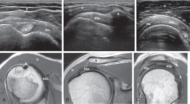Fig. 38.4, Paired ultrasound and magnetic resonance images. (A) A short axis ultrasound image of the normal long head of the biceps tendon (B) and subscapularis tendon (SSc) with corresponding axial fast spin echo (FSE) image. (B) A long axis ultrasound image of the supraspinatus tendon (SSp) and acromion (A) with corresponding oblique coronal FSE image. (C) A short axis ultrasound image in the sagittal plane depicting the infraspinatus (Isp) , supraspinatus and biceps tendons with corresponding oblique sagittal FSE image. D , Deltoid.
