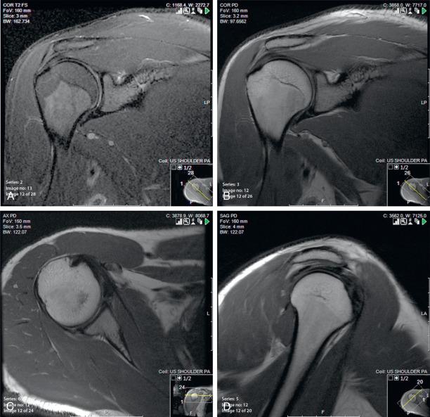 Fig. 38.5, Sample routine shoulder magnetic resonance imaging protocol, consisting of (A) oblique coronal T2 with fat saturation, (B) oblique coronal proton density, (C) axial proton density, and (D) oblique sagittal proton density.