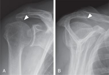 Fig. 38.6, Subacromial spur. (A) Grashey and (B) scapular Y views of the shoulder. The arrowheads point to the spur emanating off the anteroinferior acromion.