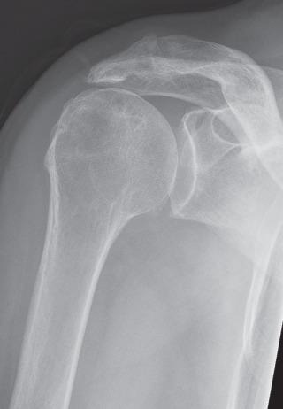 Fig. 38.7, Acromiohumeral interval. Frontal radiograph demonstrates superior migration of the humeral head and loss of the acromiohumeral interval with early acetabularization of the acromion indicating rotator cuff insufficiency. Mild glenohumeral osteoarthritis is evident.