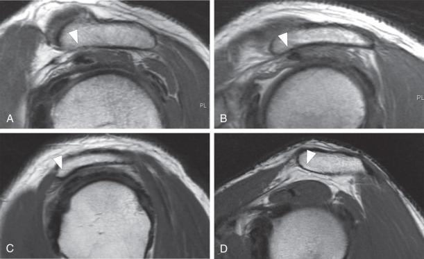 Fig. 38.8, Acromial morphology. Oblique sagittal fast spin echo images of the acromion lateral to the acromioclavicular joint. (A) A type I acromion demonstrates a flat undersurface (arrow) . (B) A type II acromion has a gentle curvature to the undersurface of the acromion (arrows) . (C) A type III acromion demonstrates a hook (arrow) extending off the anterior aspect of the acromion. (D) A type IV acromion demonstrates a curved acromial undersurface (arrow) .