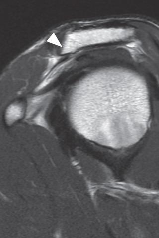 Fig. 38.10, Subacromial enthesophyte. Sagittal oblique fast spin echo (FSE) image demonstrates a marrow containing osseous excrescence extending off the anterior acromion (arrowhead) . Note that an enthesophyte contains marrow signal that is high to intermediate in signal on FSE images, which differs from the coracoacromial ligament attachment, which is of low signal intensity on all pulse sequences.