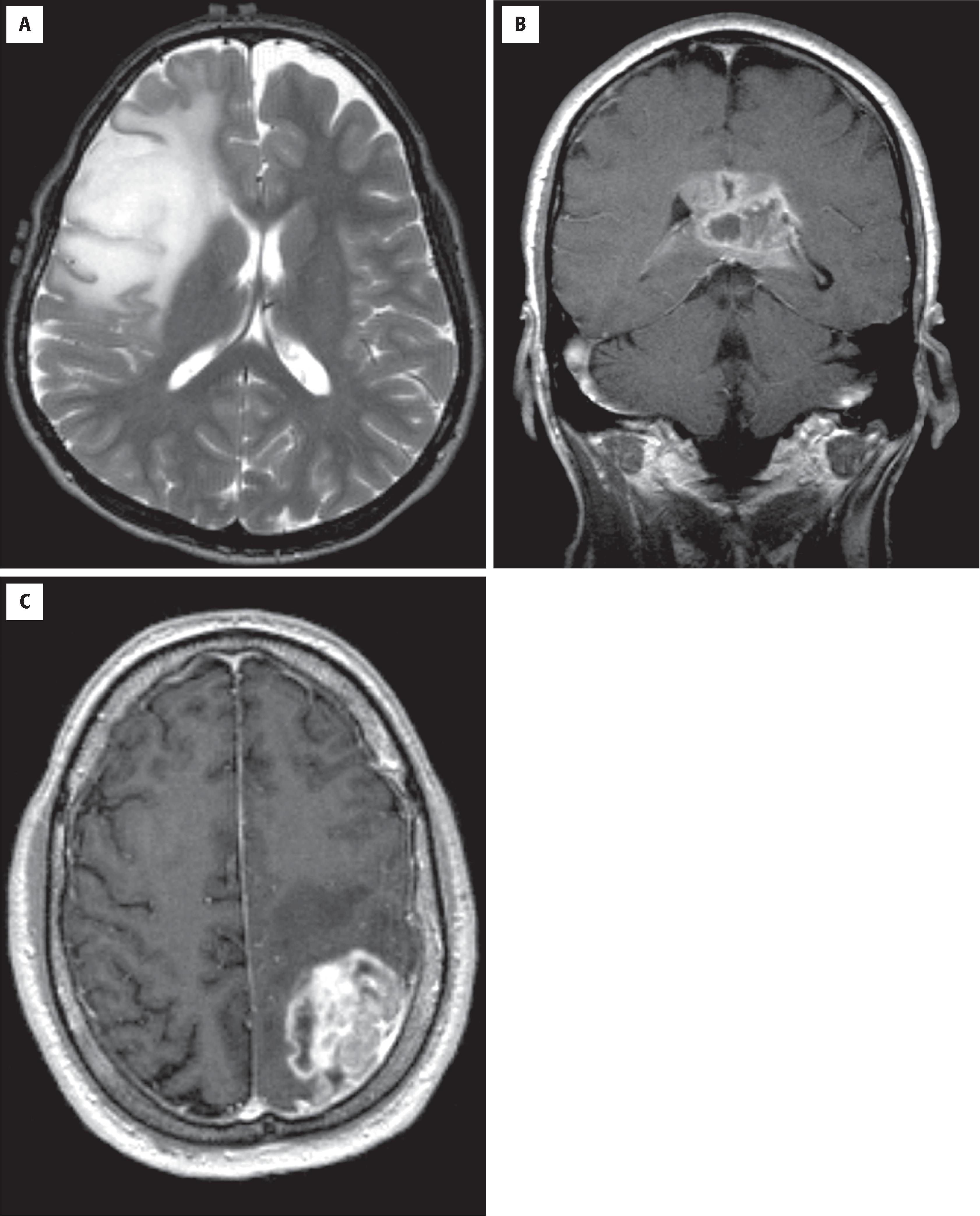 FIGURE 9.1, Representative magnetic resonance images from patients with diffuse astrocytoma, glioblastoma, and radiation necrosis. ( A ) Diffuse astrocytoma, grade 2. A T2-weighted image shows ill-defined margins and increased signal in the white matter and cortex. ( B ) Glioblastoma. A T1-weighted image with gadolinium contrast shows a deep-seated, ring-enhancing mass that crossed the corpus callosum. ( C ) Radiation necrosis in a treated glioblastoma patient (difficult to distinguish from tumor recurrence). A T1-weighted image with gadolinium contrast shows a heterogeneously enhancing mass.