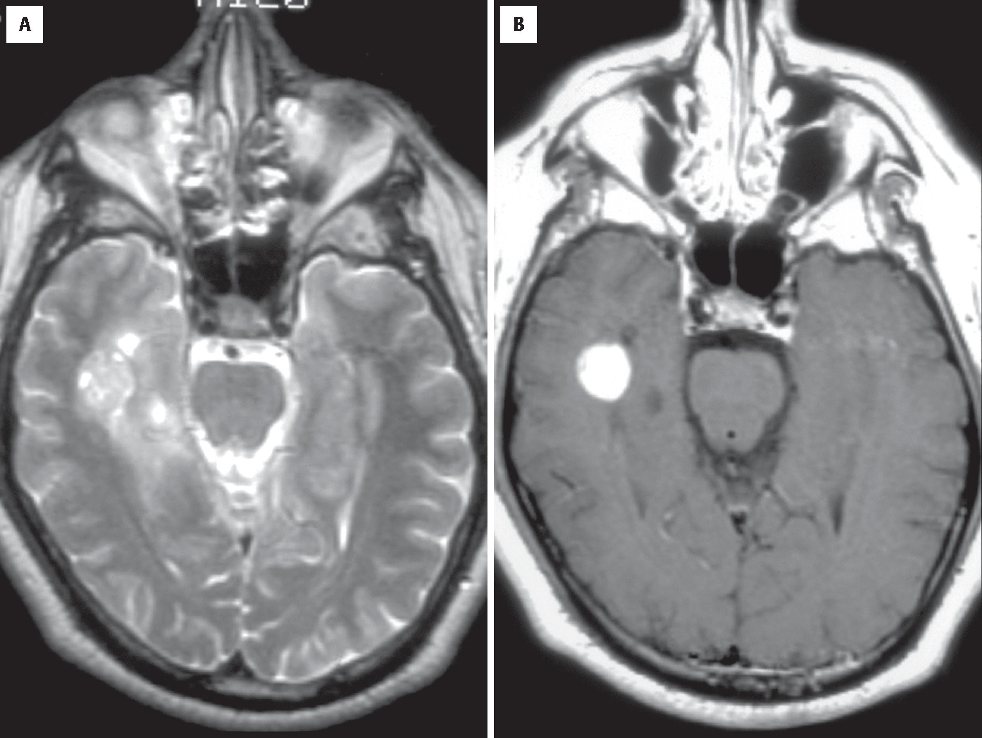 FIGURE 9.11, Magnetic resonance imaging in a patient with pleomorphic xanthoastrocytoma. T2-weighted ( A ) and T1-weighted ( B ) images with contrast show a well-demarcated, partially cystic, enhancing, right temporal lobe mass.