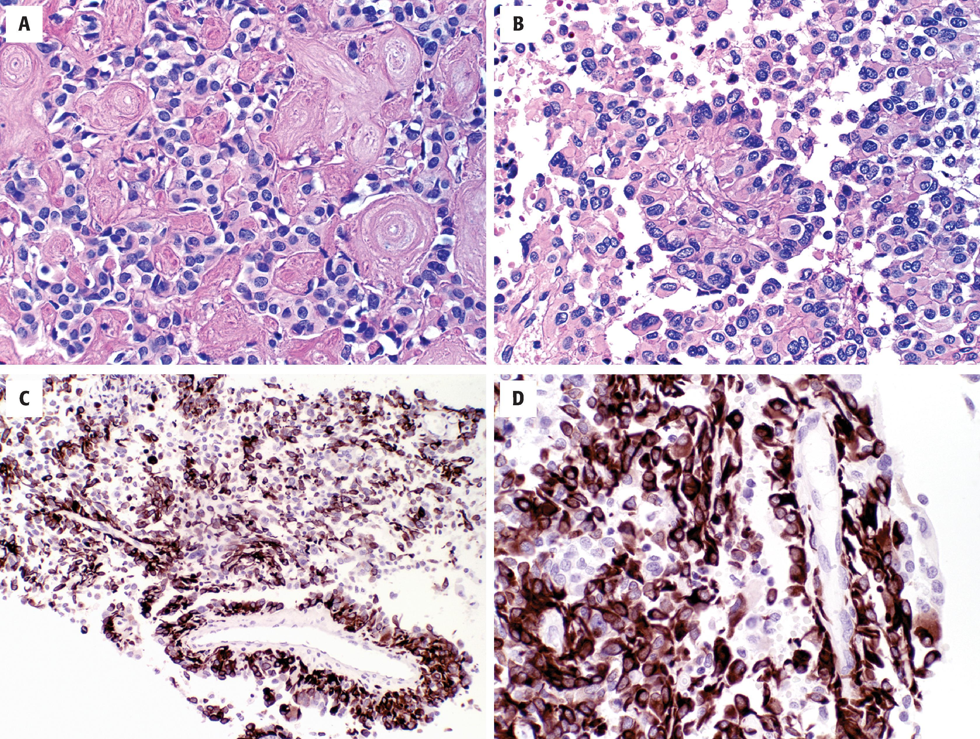 FIGURE 9.13, Astroblastoma. ( A ) Epithelioid cytology and extensive perivascular and stromal hyalinization. ( B ) Perivascular pseudorosette with broad tumoral cell processes. ( C, D ) Strong glial fibrillary acidic protein expression with broad tumoral processes surrounding vessels.