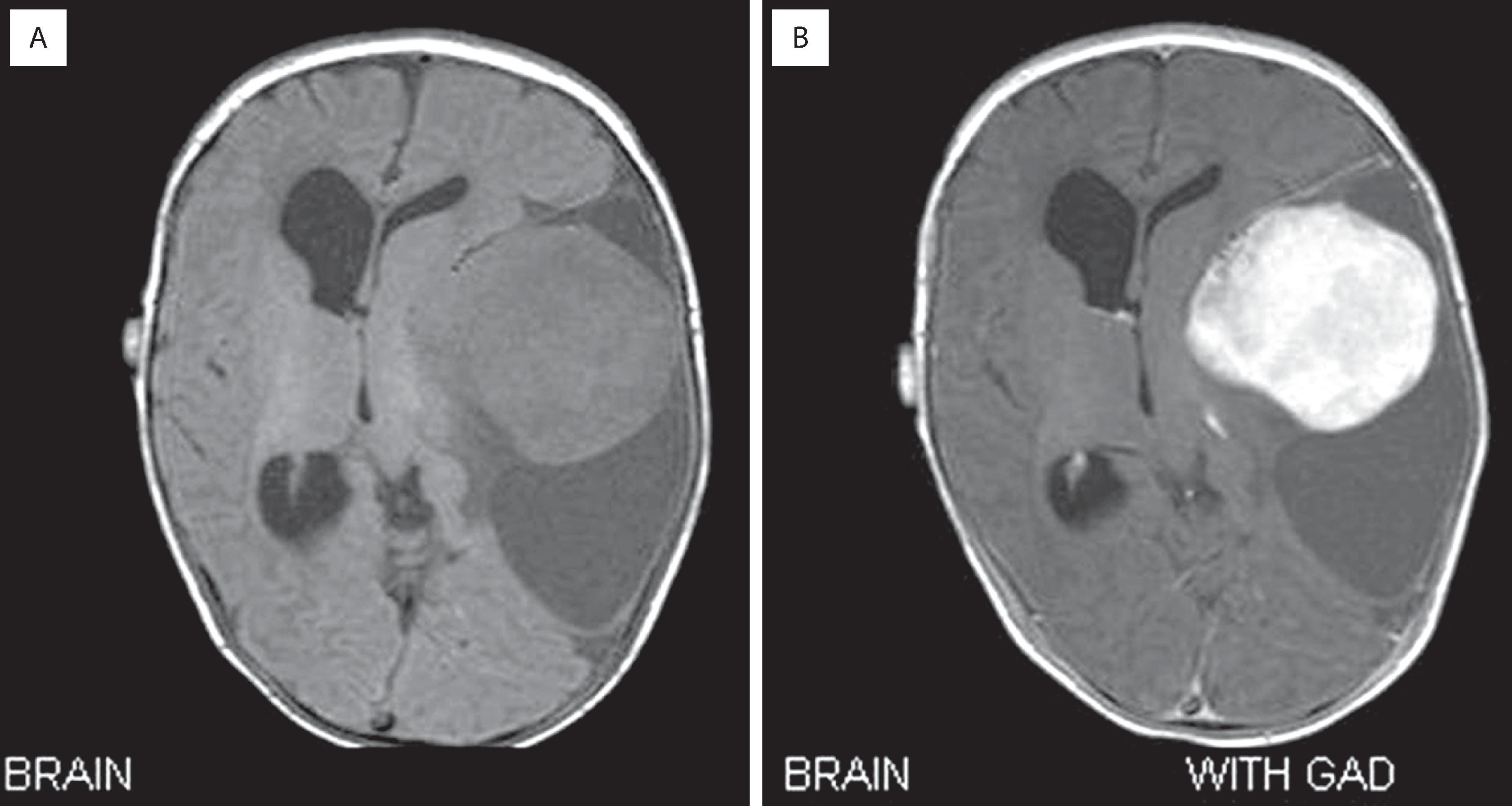 FIGURE 9.14, T1-weighted magnetic resonance imaging without ( A ) and with ( B ) contrast in a patient with desmoplastic infantile ganglioglioma. A massive, superficial cystic mass with an enhancing nodule is apparent.