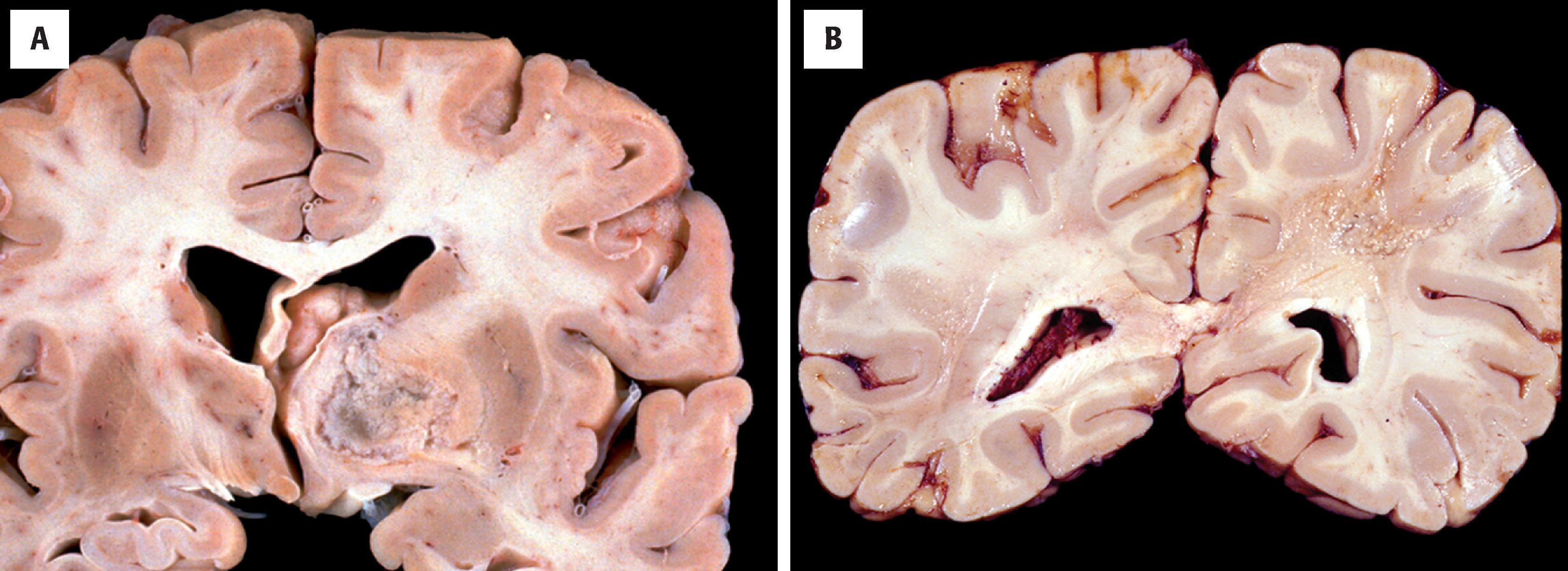 FIGURE 9.2, Similar gross appearance of glioblastoma ( A ) and radiation necrosis ( B ) with variegated necrotic masses.