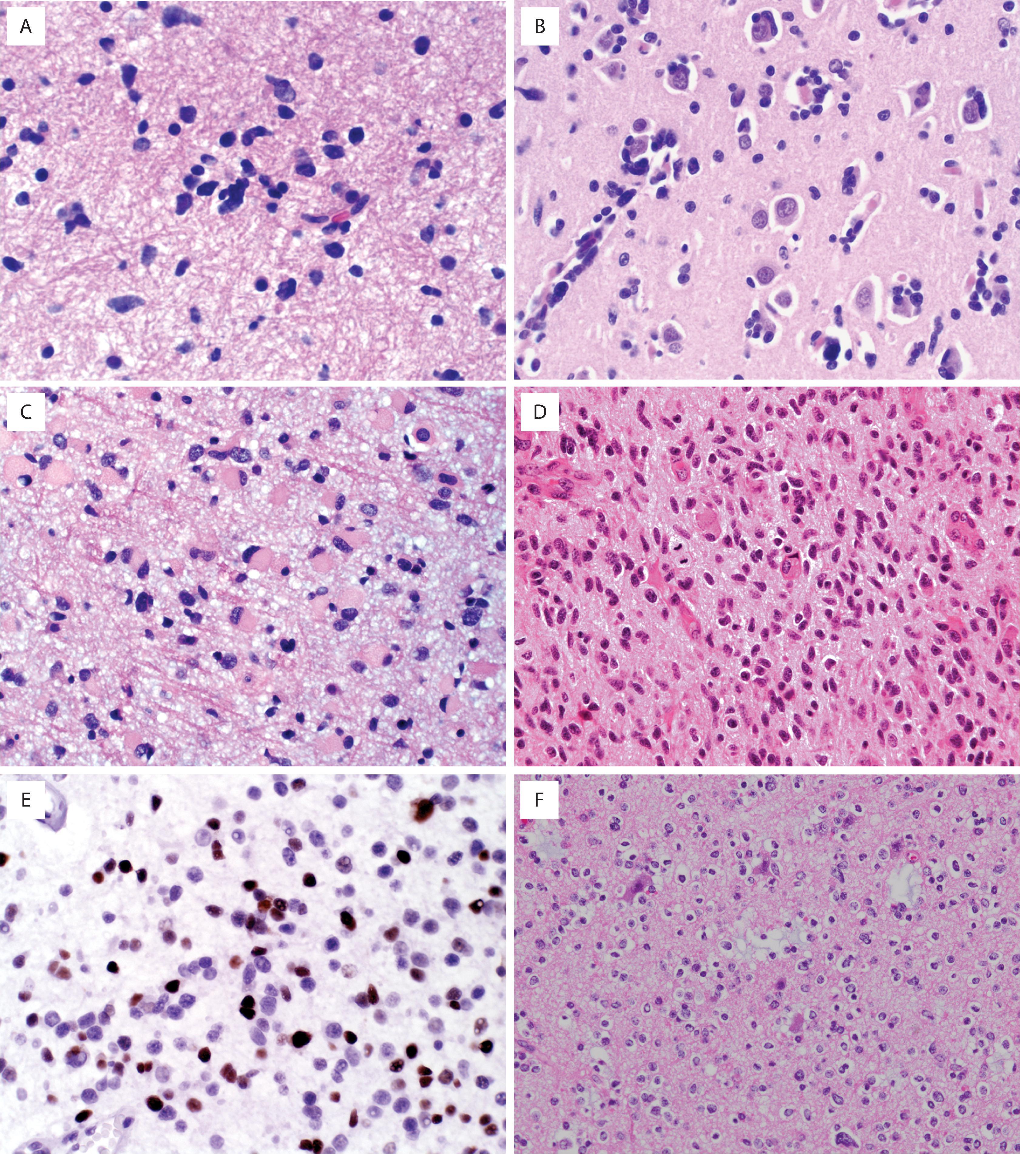 FIGURE 9.3, Diffuse astrocytomas. ( A ) Cluster of mildly enlarged, elongated, or irregular, hyperchromatic naked nuclei intermingled with native non-neoplastic cells in a grade 2 astrocytoma. ( B ) Secondary structures of Scherer with perineuronal satellitosis and perivascular aggregation of tumor cells. ( C ) Gemistocytic component in astrocytoma. ( D ) Moderate cellularity and mitotic activity in WHO grade 3 astrocytoma. ( E ) MIB-1 (Ki-67) immunostain showing increased labeling index in high-grade astrocytoma. ( F ) Morphologically astrocytoma may be indistinguishable from oligodendroglioma. ( G ) Immunohistochemistry for IDH1 R132H (mutant protein) is positive. ( H ) ATRX loss (no immunostaining in tumor cells) consistent with diffuse astrocytoma. ( I ) Microvascular proliferation in glioblastoma. ( J ) Pseudopalisading necrosis in glioblastoma.