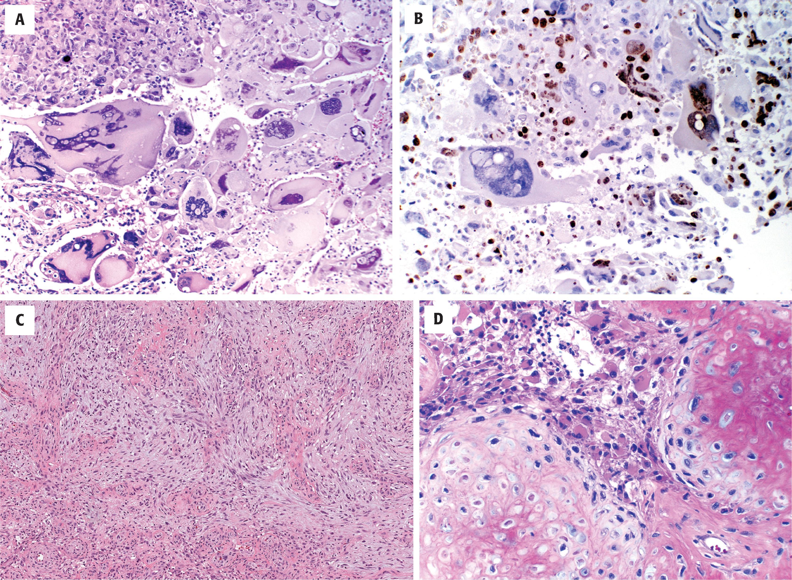 FIGURE 9.4, Glioblastoma subtypes. ( A ) Huge mononucleated and multinucleated giant tumor cells. ( B ) Most of the proliferative activity is in the intervening small tumor cells, but some of the giant cell nuclei are also stained with MIB978-0-323-71344-3. ( C ) Gliosarcoma with spindled mesenchymal morphology. ( D ) Gliosarcoma with extensive cartilaginous differentiation in the sarcomatous element. The glial component is predominantly gemistocytic in this example. FIGURE 9.4, cont’d( E ) Small cell glioblastoma with monomorphous, deceptively bland oval nuclei, chicken wire–like vessels, and a high mitotic index. This is often mistaken for oligodendroglial differentiation. ( F ) Oligodendroglioma grade 3 with rounder nuclei and mucin-filled microcystic spaces. ( G ) Epithelioid glioblastoma with discrete cell boundaries. ( H ) Granular cell glioblastoma with large cells marked by an accumulation of cytoplasmic lysosomes accounting for the granularity of the cytoplasm.