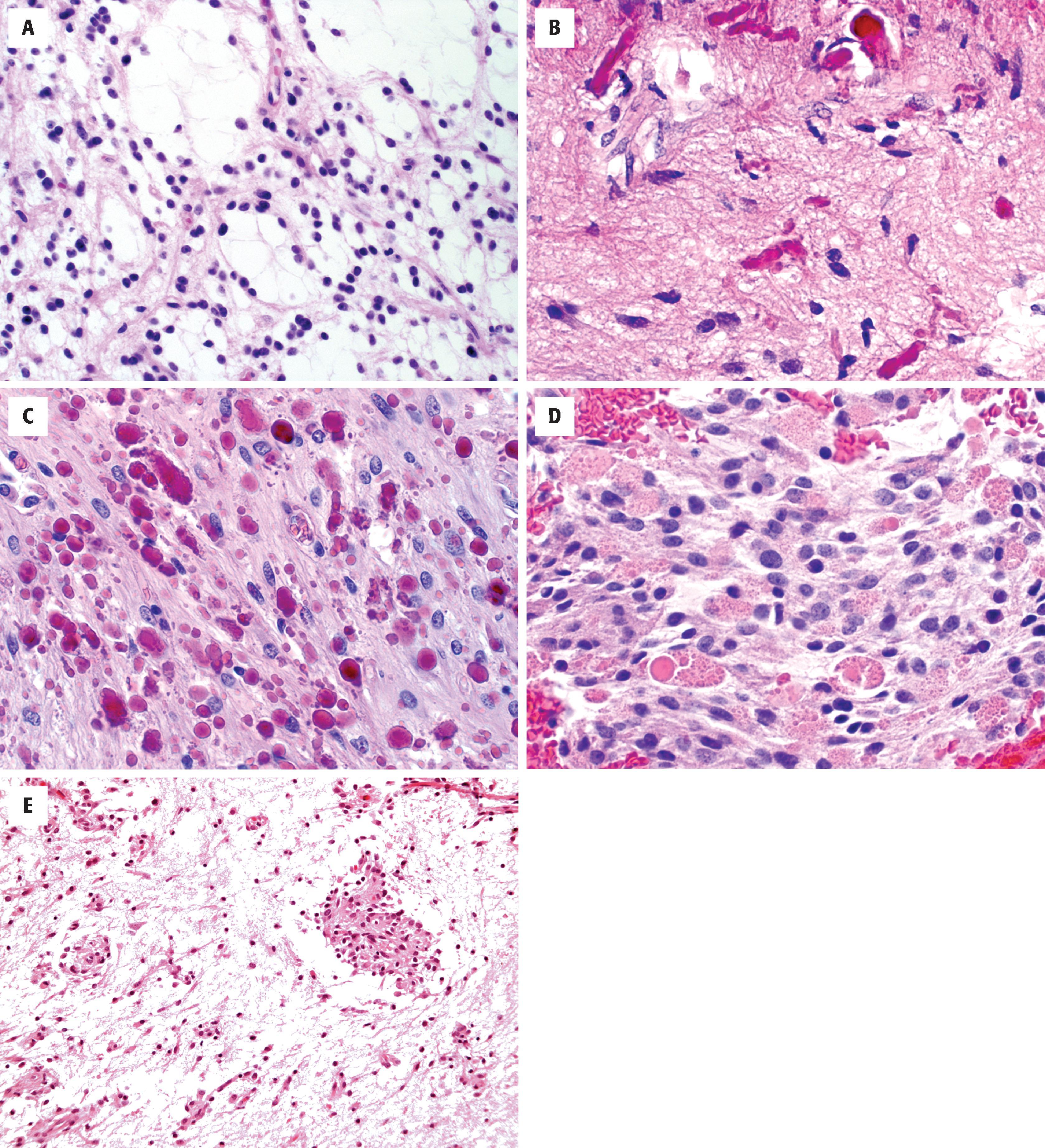FIGURE 9.8, Pilocytic astrocytomas with spindled astrocytes containing long, thin processes; loose microcystic foci ( A ); dense foci with Rosenthal fibers ( B , C ), and abundant eosinophilic granular bodies ( D ). Pilomyxoid astrocytoma ( E ) with a perivascular arrangement of tumor cells.