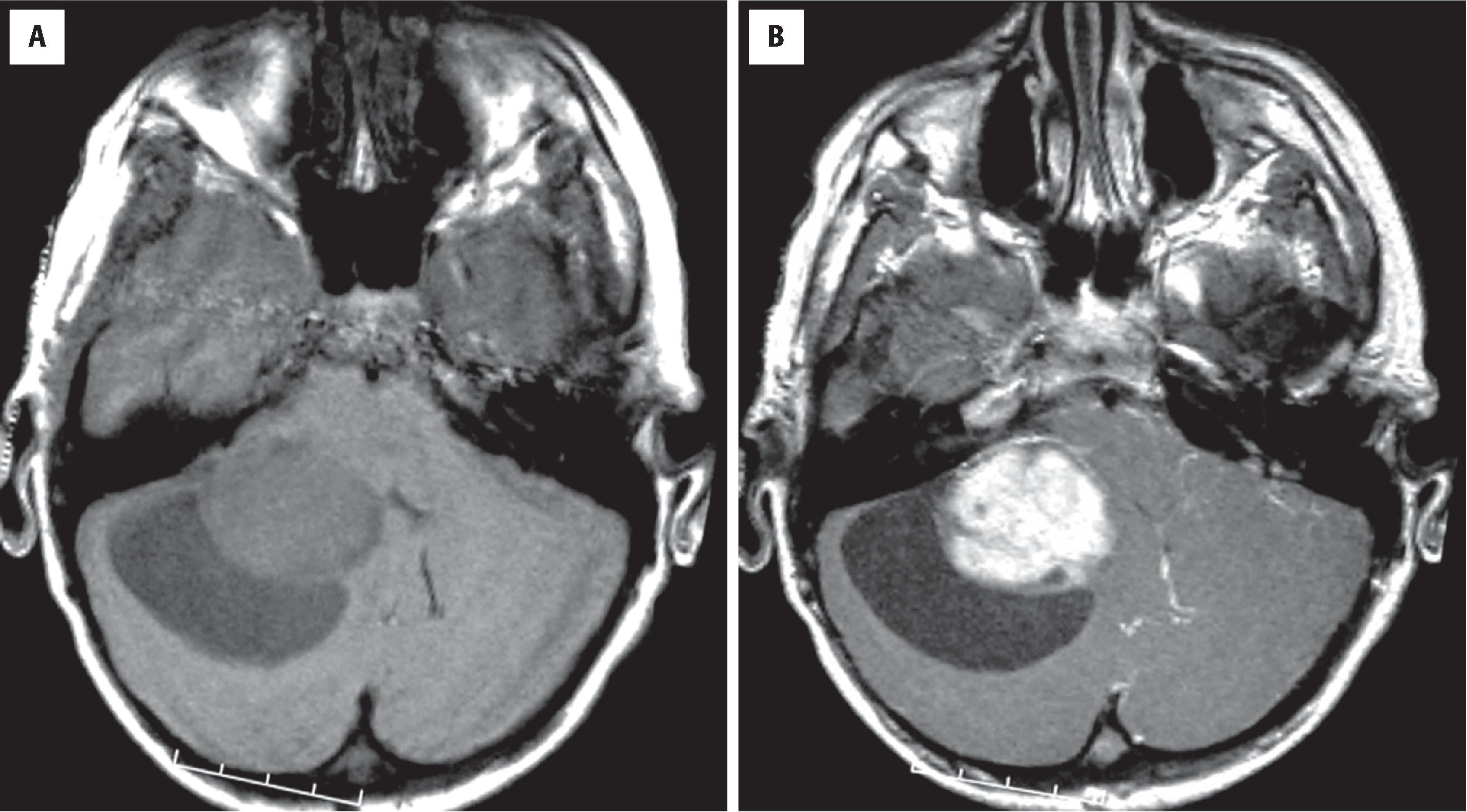 FIGURE 9.7, Pilocytic astrocytoma of the cerebellum. T1-weighted magnetic resonance imaging without ( A ) and with ( B ) contrast shows a cyst with an enhancing mural nodule.