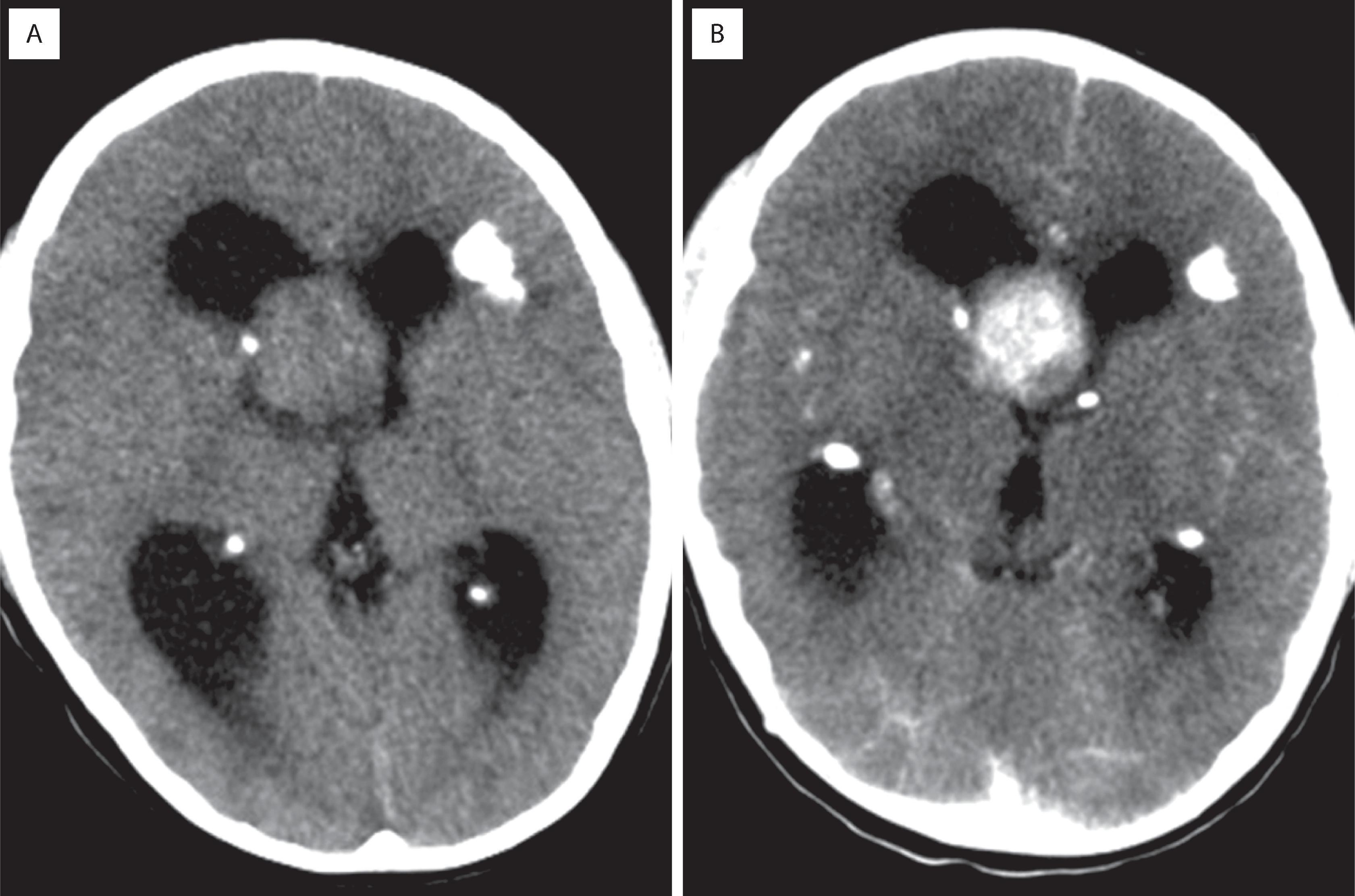 FIGURE 9.9, Computed tomography scans without ( A ) and with ( B ) contrast from a patient with a subependymal giant cell astrocytoma showing an enhancing intraventricular mass near the foramen of Monro with obstructive hydrocephalus. Also note the calcified tuber in the left frontal lobe of this patient with tuberous sclerosis.