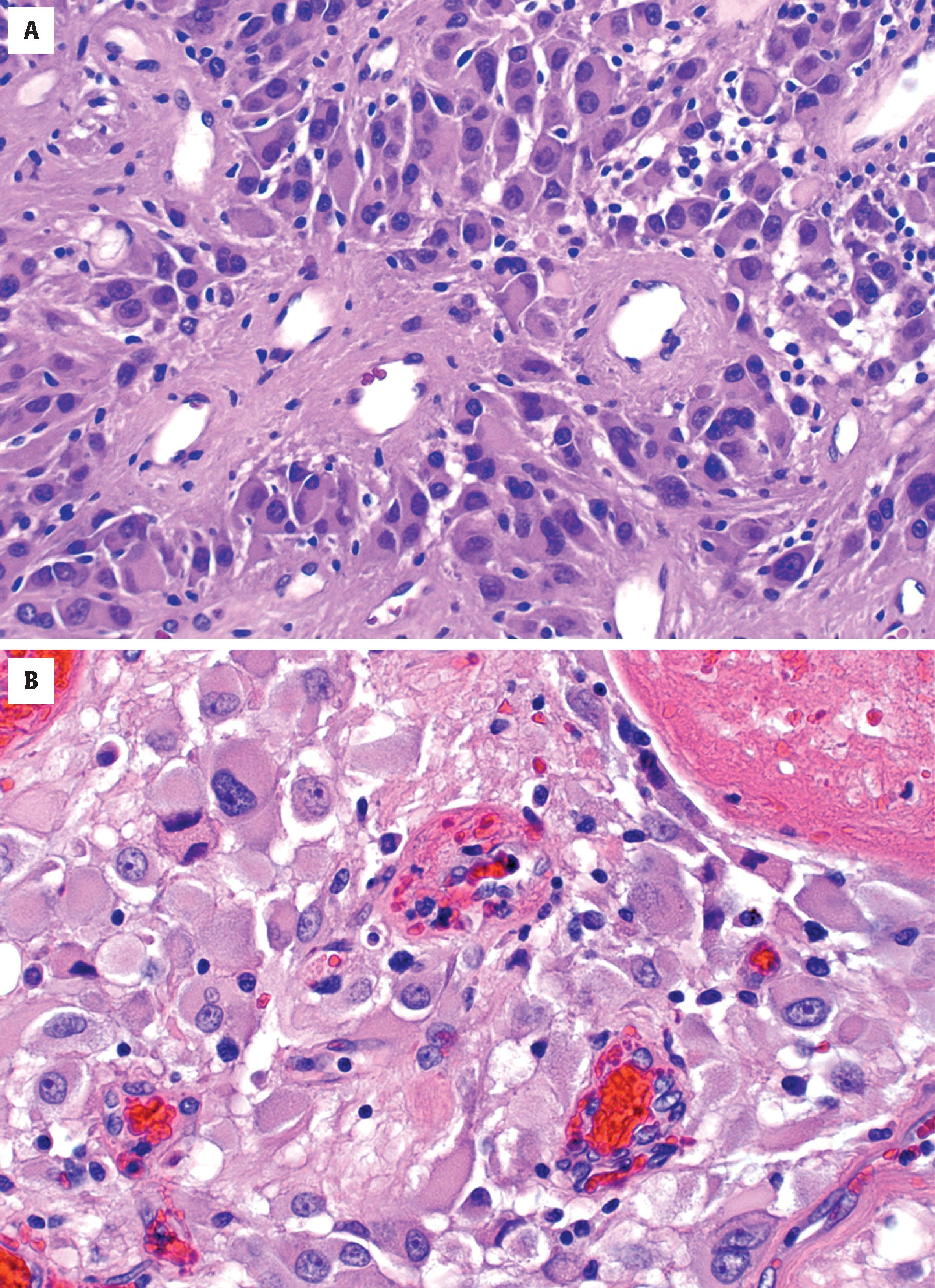 FIGURE 9.10, Examples of subependymal giant cell astrocytoma highlighting perivascular pseudorosettes ( A ) and typical cytologic features ( B ), including neuronal-like nuclei and astrocyte-like cytoplasm.