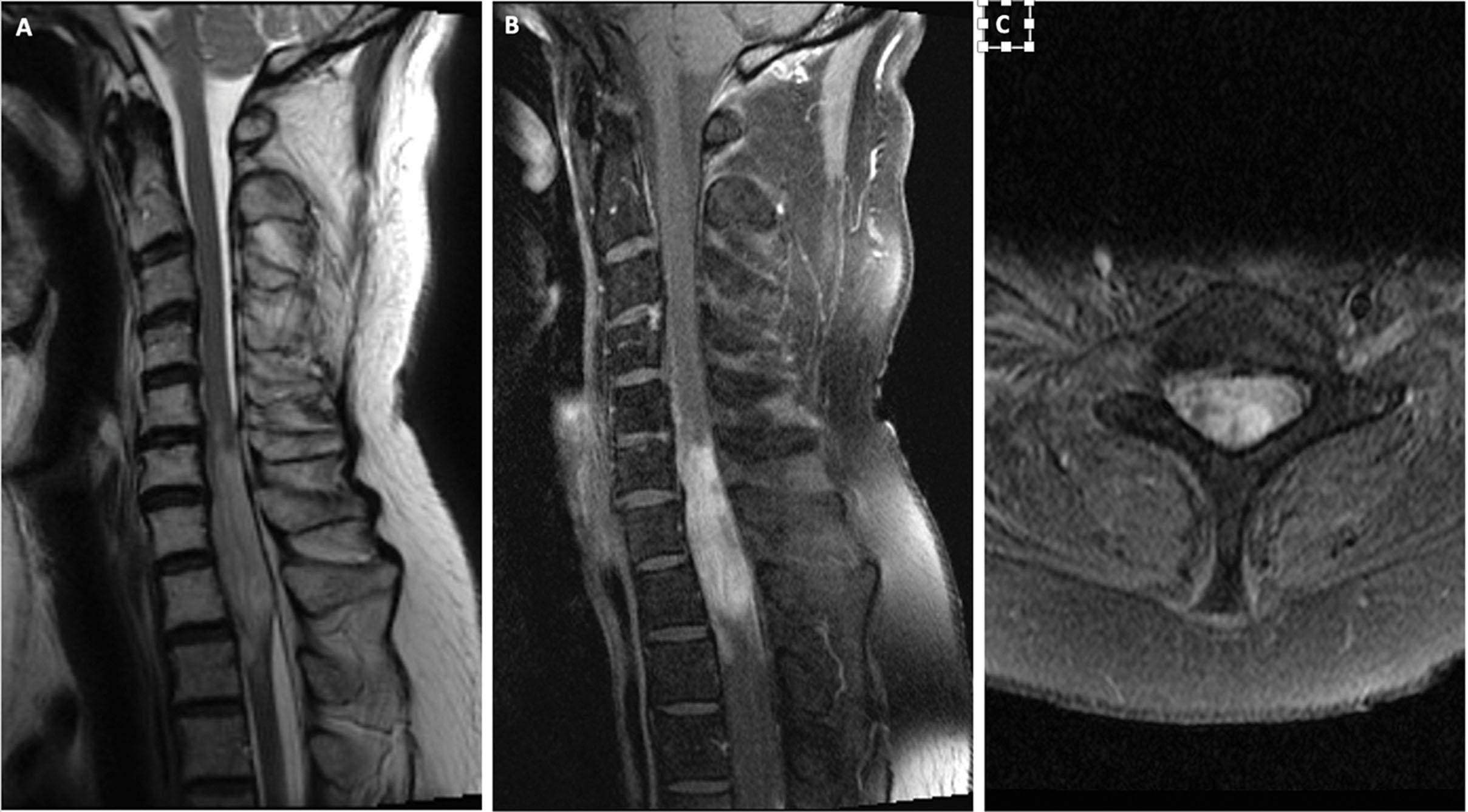 Fig. 56.1, Preoperative magnetic resonance image (MRI) of the cervical spine. (A) Sagittal T2 image demonstrating an intramedullary lesion extending from C6 to T2 levels that has a high signal intensity and is causing a diffuse spinal cord expansion. This is more pronounced at the C7-T1 level and associated with mild tumor-related edema spreading inferiorly (T2). (B) Sagittal and (C) axial T1 with contrast images demonstrating an intramedullary space-occupying mass with avid enhancement. The lesion is slightly heterogenous and displays ill-defined borders.