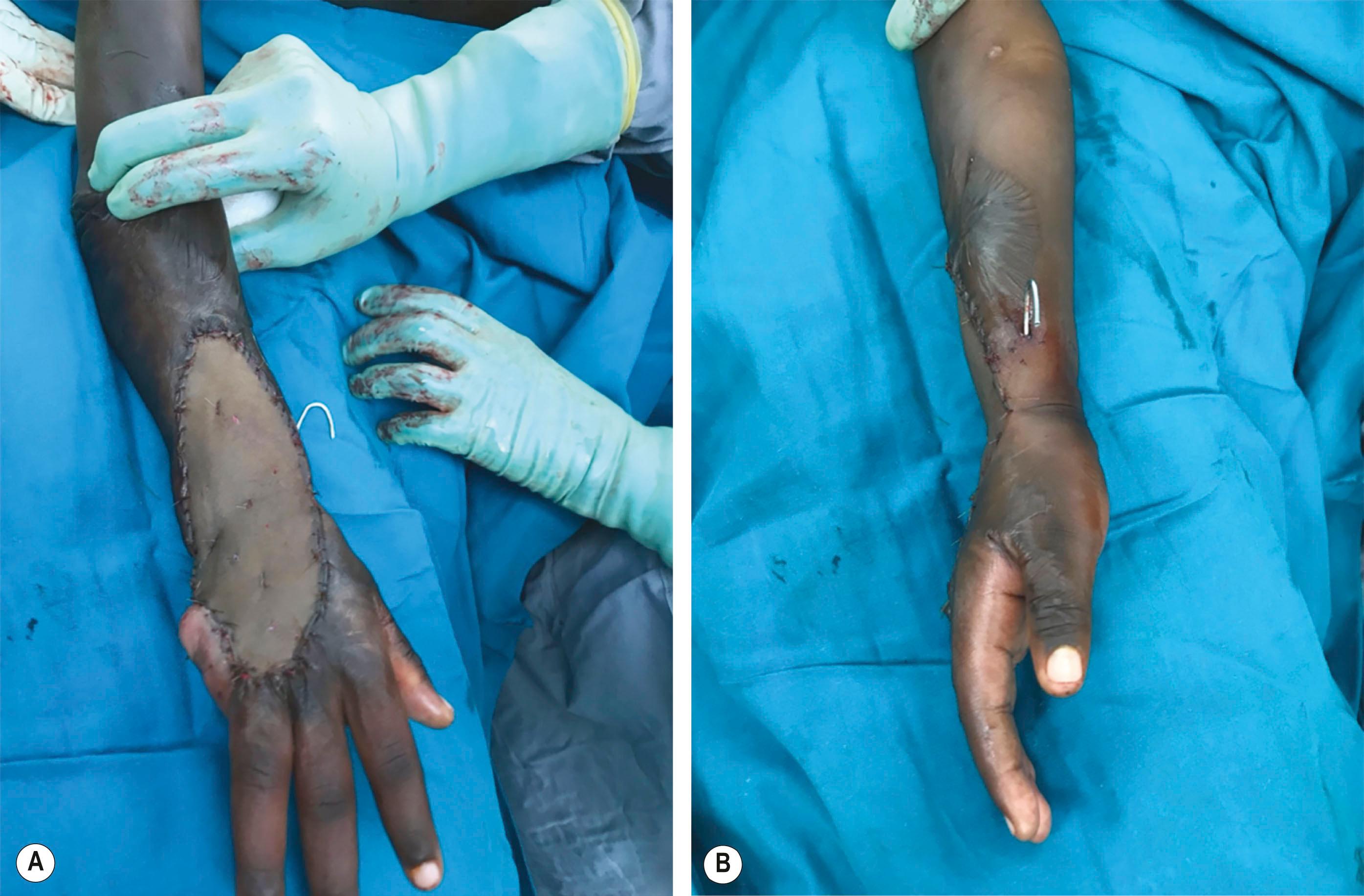 Figure 38.3, (A,B) Postoperative photographs of right forearm and hand scald injury. Burn contracture release with full-thickness skin grafting and pinning at the wrist and casting (to maintain wrist extension) was performed. Fillet of the small finger was performed to increase functionality, provide additional soft-tissue coverage, and maintain sensation on the ulnar border of the hand. The pin was removed after 2 weeks and physiotherapy prescribed.