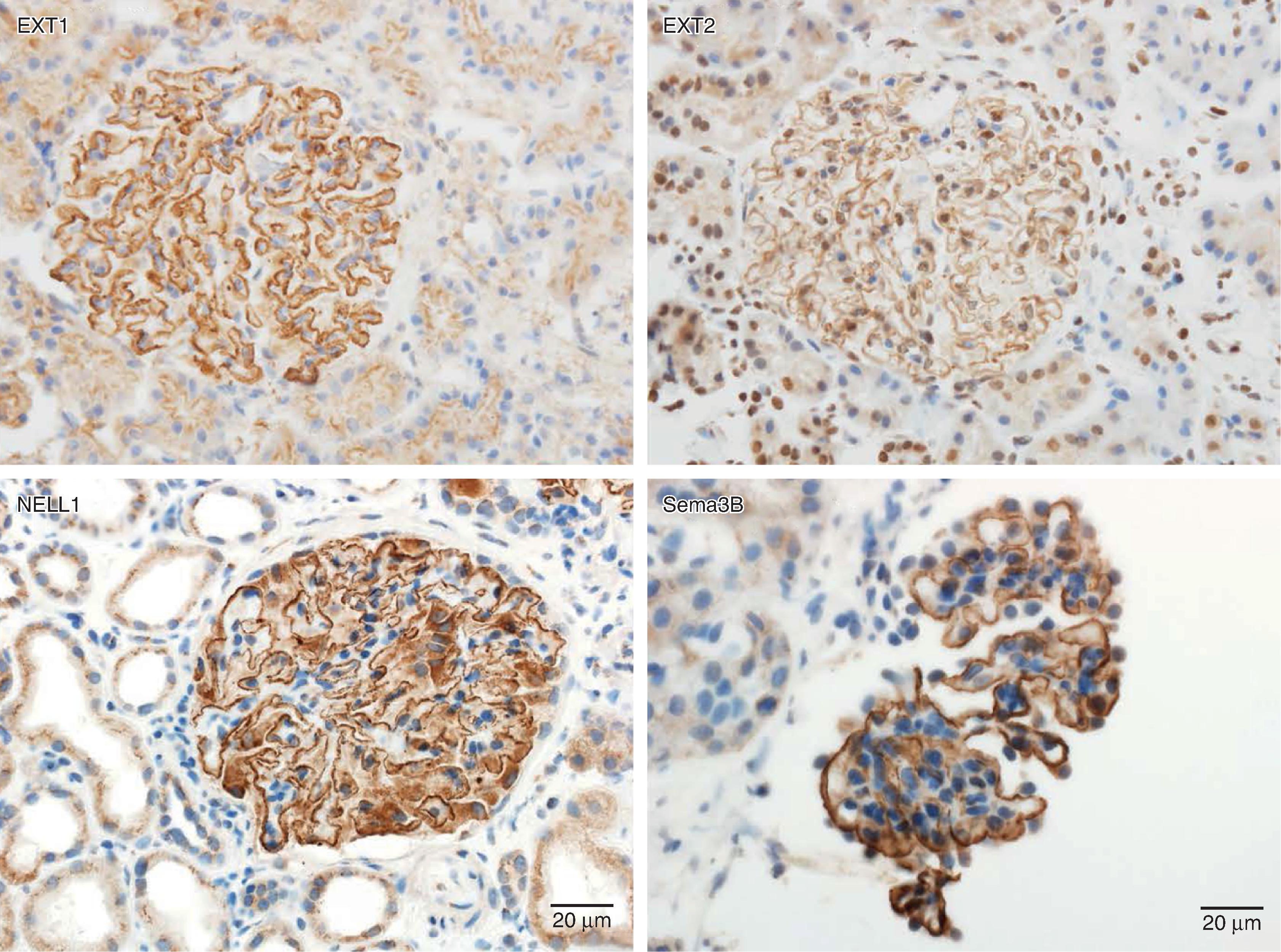 Fig. 16.2, New antigens in MN: immunohistochemistry showing granular staining for EXT1, EXT2, NELL1, and Sema3 along the capillary wall. EXT1 and EXT2 are from the same case; NELL1 and Sema3B represent one case each (all ×40).