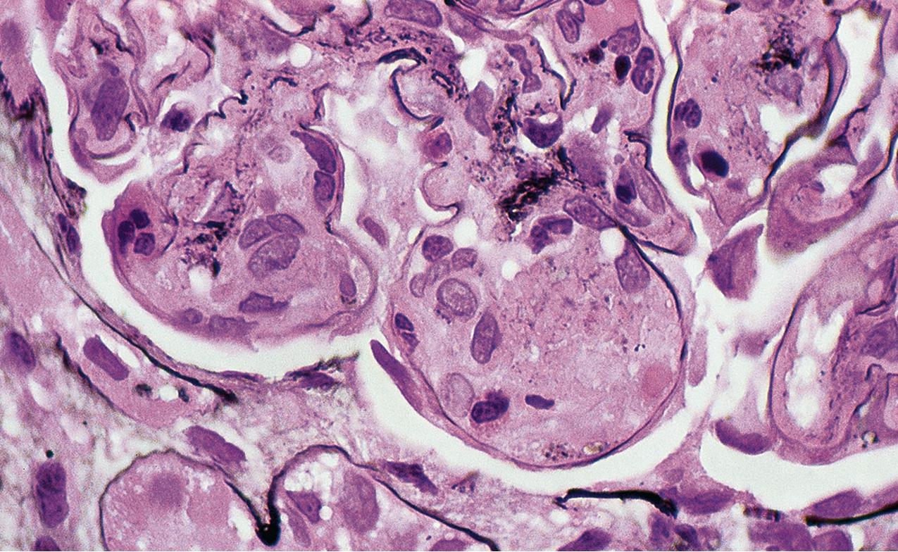 FIG. 3.101, Membranoproliferative glomerulonephritis (MPGN).