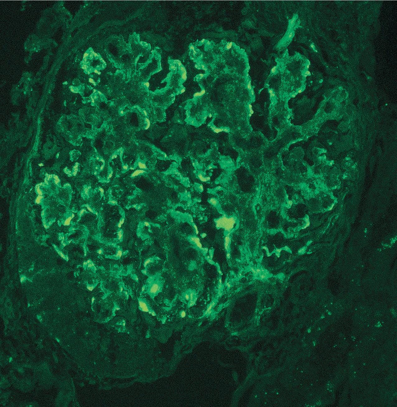 FIG. 3.104, Membranoproliferative glomerulonephritis (MPGN).